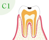 むし歯の進行：C1