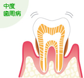 中度歯周病