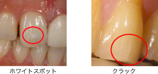 ホワイトスポットとクラック